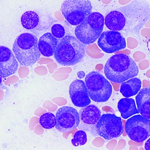 Blood cancer causes and treatment